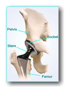 Pelvis Stem Socket Femur